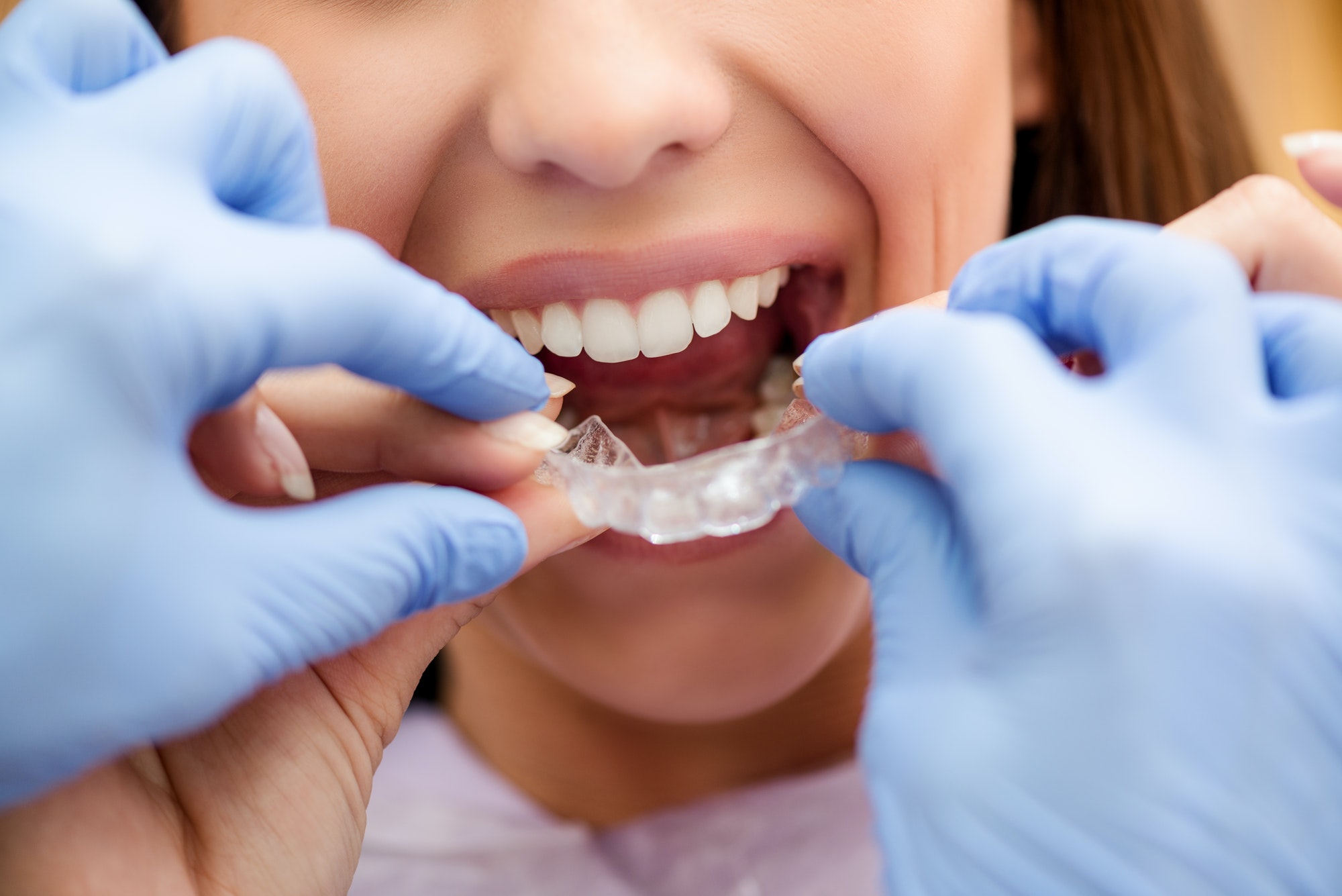 Fundas tratamiento ortodoncia
